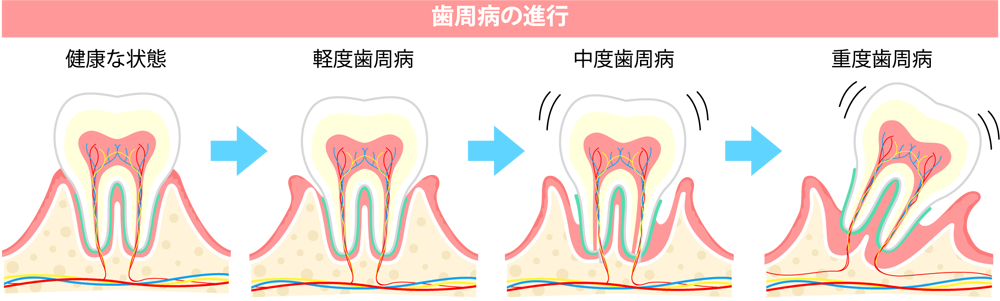 歯周病のステップ