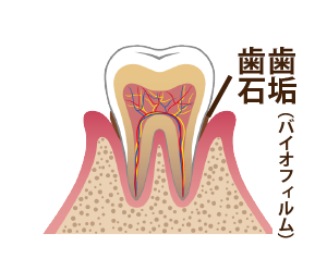 歯周病進行具合2−細菌繁殖