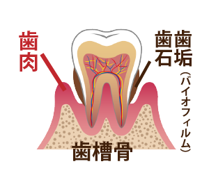 歯周病進行具合3−歯肉炎