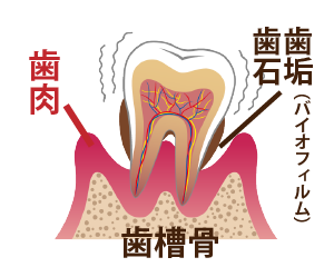 歯周病進行具合4−歯周炎