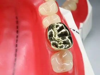 奥歯　従来の銀歯