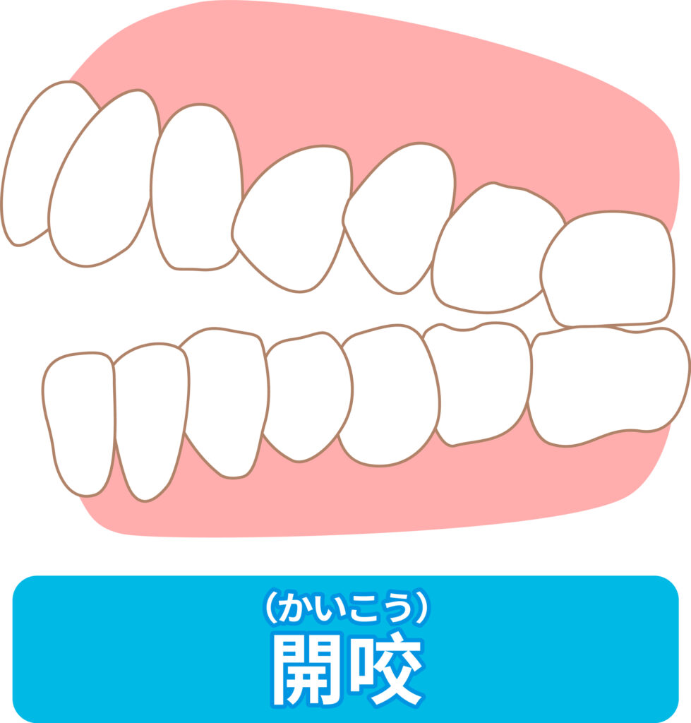 開咬