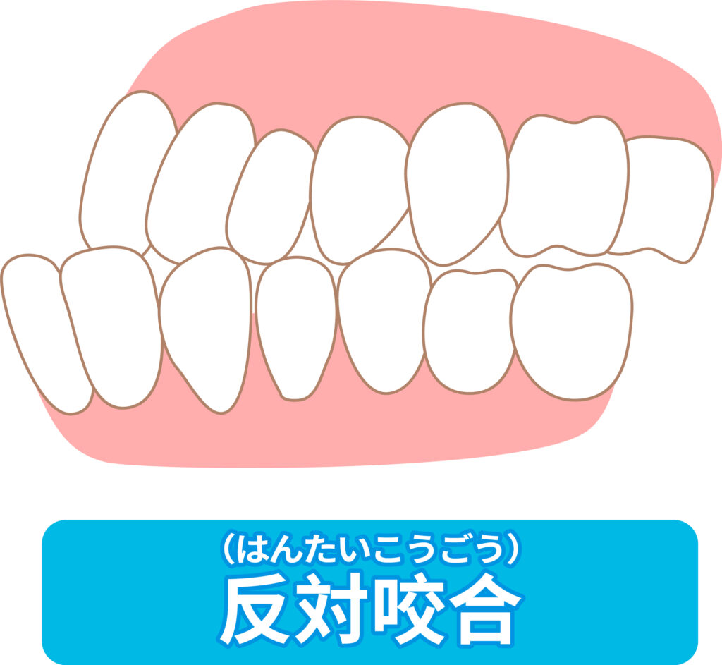 反対咬合・受け口