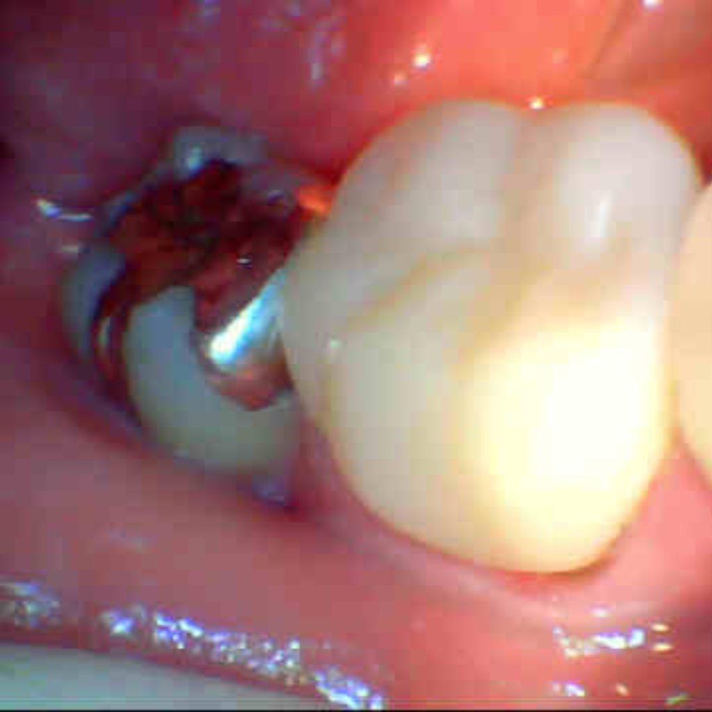 CadCam冠インレイ(治療前)