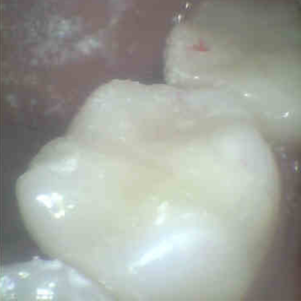 CadCam冠 左下(治療後)