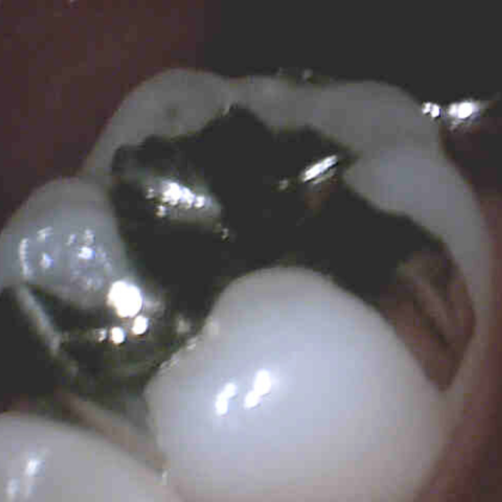 CadCam冠 左下(治療前)