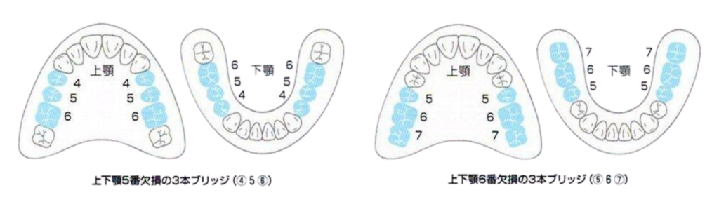 保険適用のブリッジSHIN-BOW適用箇所